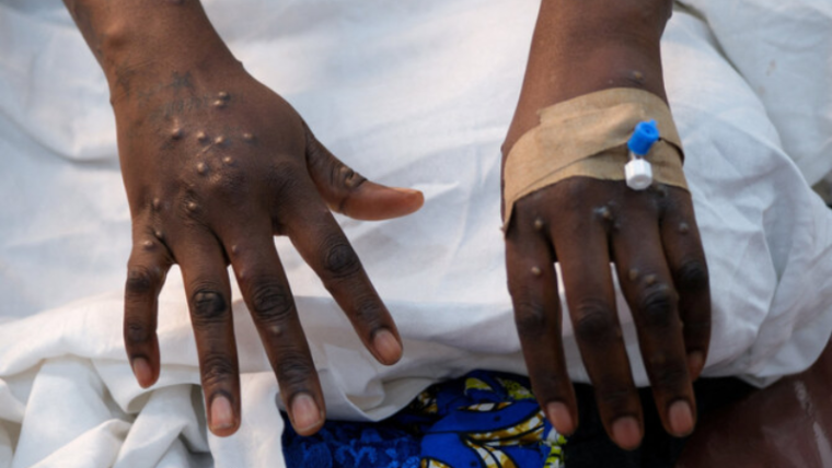 New case of monkeypox in Morocco