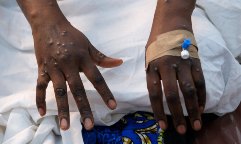 New case of monkeypox in Morocco