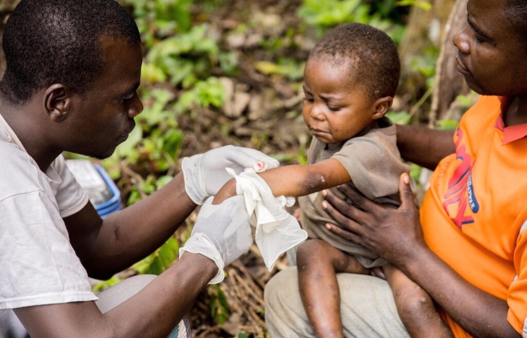 Over 1,000 Deaths Due to Monkeypox in the African Continent